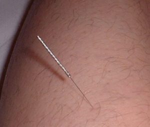 Dry Needling