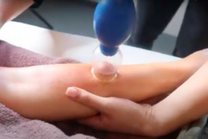 Cupping Kim van Iersel