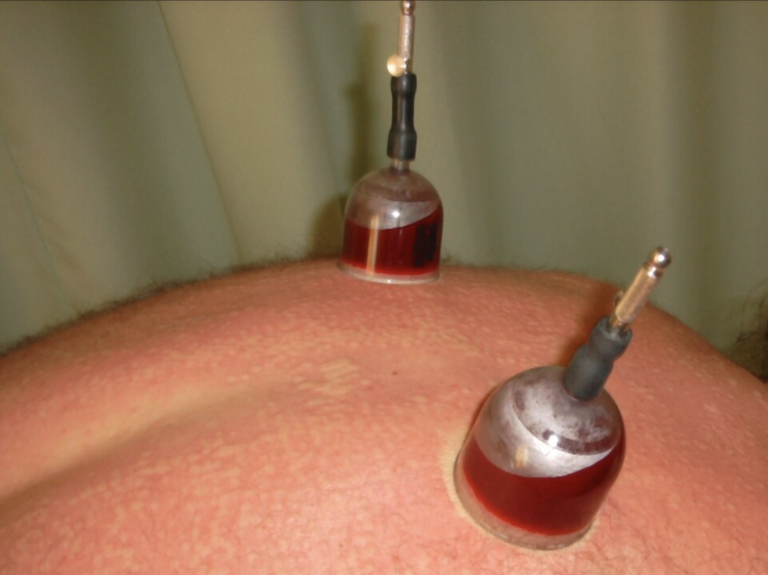 ‘Wet cupping’-praktijken overtreden de wet